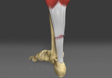 Achilles Tendon Rupture