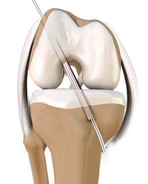 Minimally Invasive Knee Joint Replacement