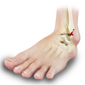 Ankle Fractures