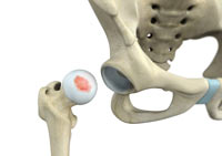 Hip Injury