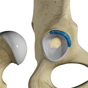 Hip Trauma Reconstruction