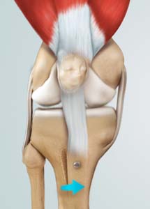 Knee Osteotomyt