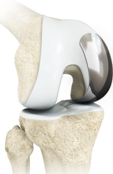 Unicompartmental/Partial Knee Replacement