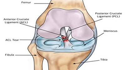 ACL Injury