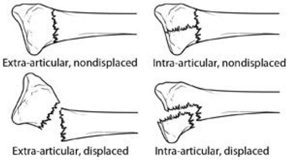 What You Need To Know About A Broken Wrist