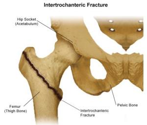 Hip Fracture