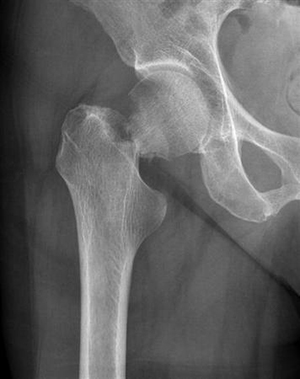 Hip Fracture