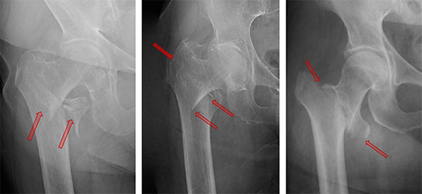 Hip Fracture