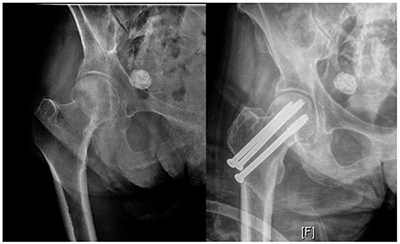 Hip Fracture