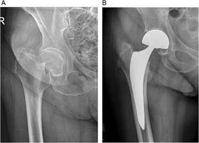 Hip Fracture