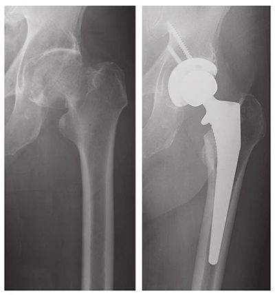 Hip Fracture