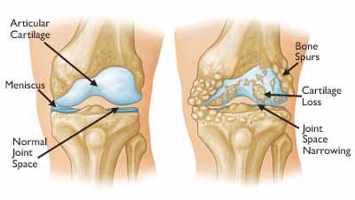 Osteoarthritis of the Knee